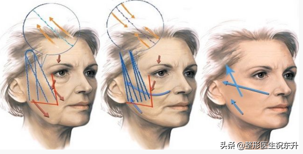 医生不会告诉你的 | 做“面部线雕”用这几种线材，差别有多大？