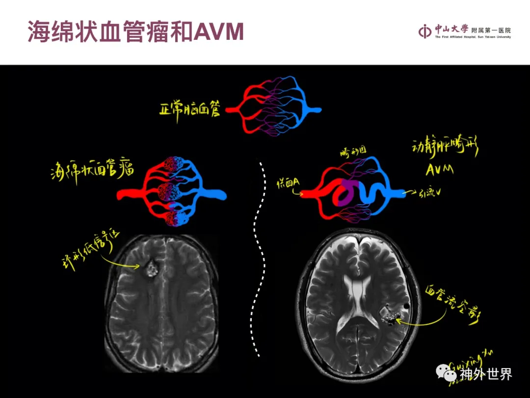 最全影像总结 | 颅内病变 MR、CT 的阅片技巧，太赞了