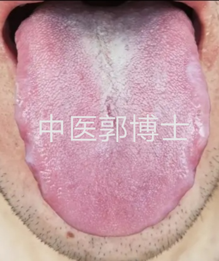 郭博说舌象（4）舌边齿痕，多脾虚腹泻；舌根黄腻苔，考虑前列腺
