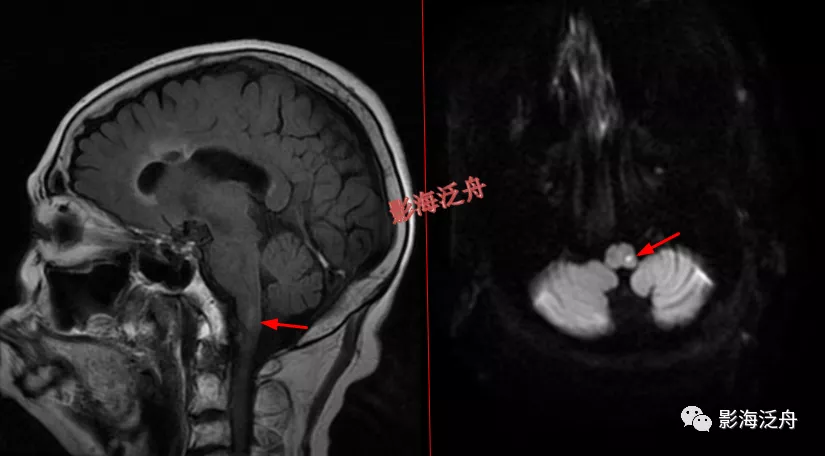 超级干货--颅脑MR中易漏诊点全面总结