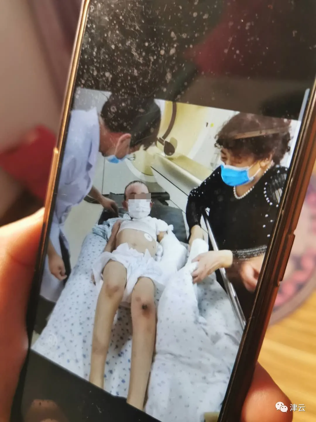 开水浇头、烟头烫疤、钳子拔牙……遭亲妈男友虐待,6岁女童伤情鉴定出炉