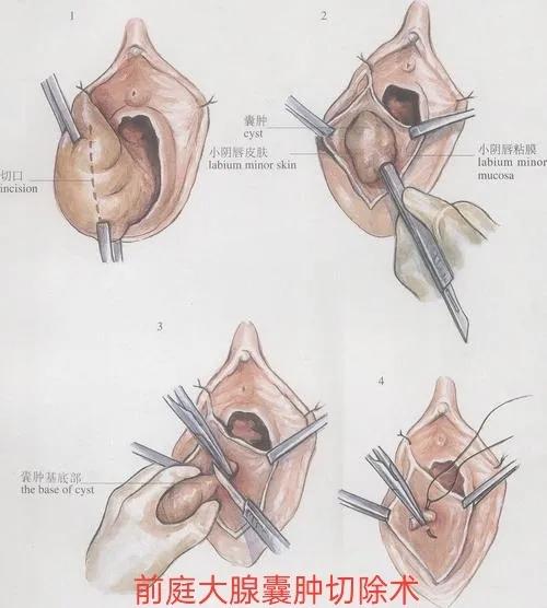 这些外阴包块一定要早治 海纳百川宁静致远 Mdeditor