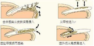 甲癣是这么回事，强调：必须重视