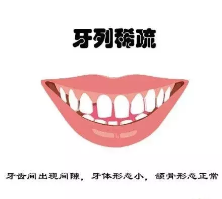 什么牙需要矫正呢？