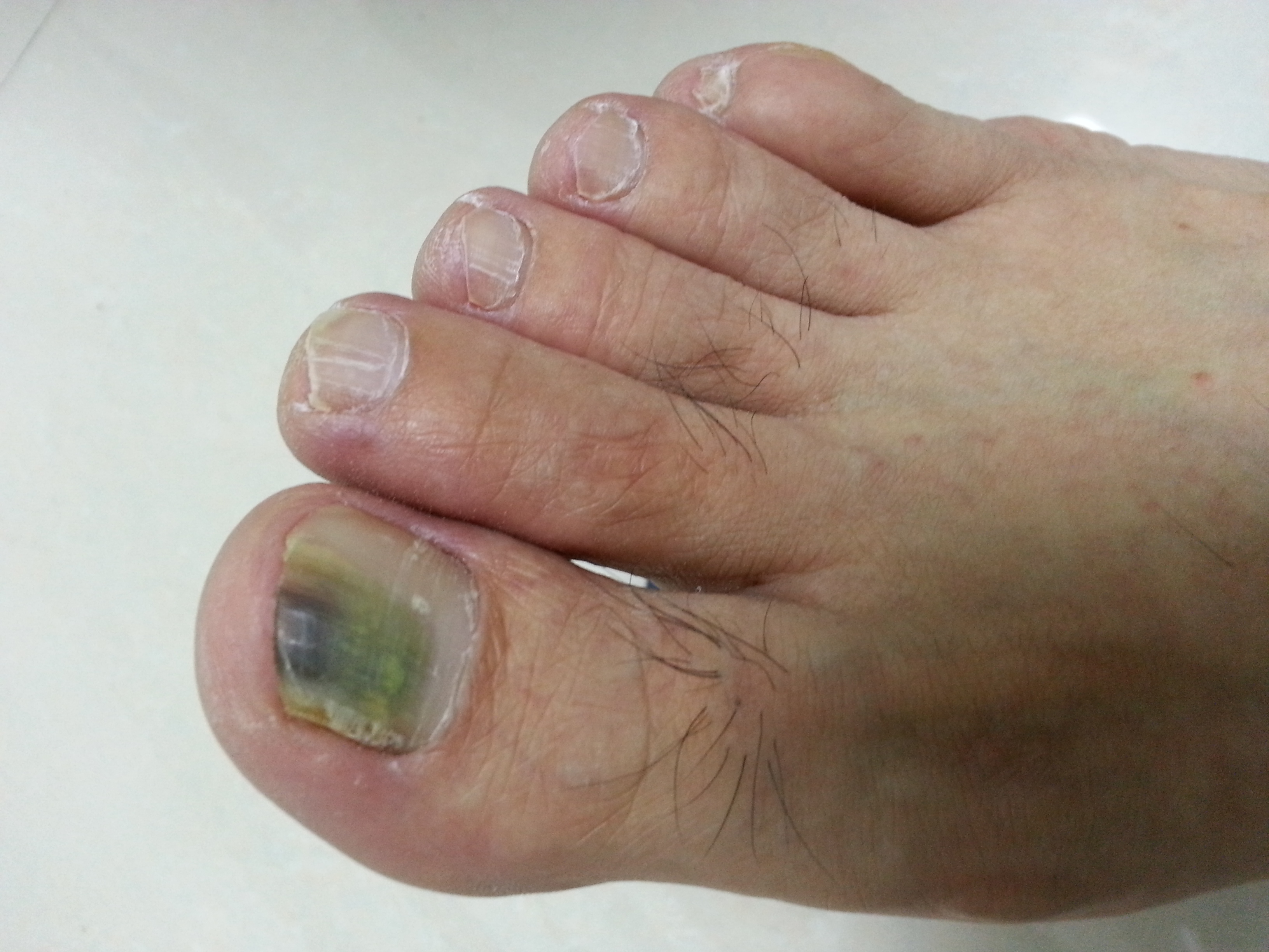 黑黑的趾甲和藍色的趾甲 護膚在西塘 Mdeditor