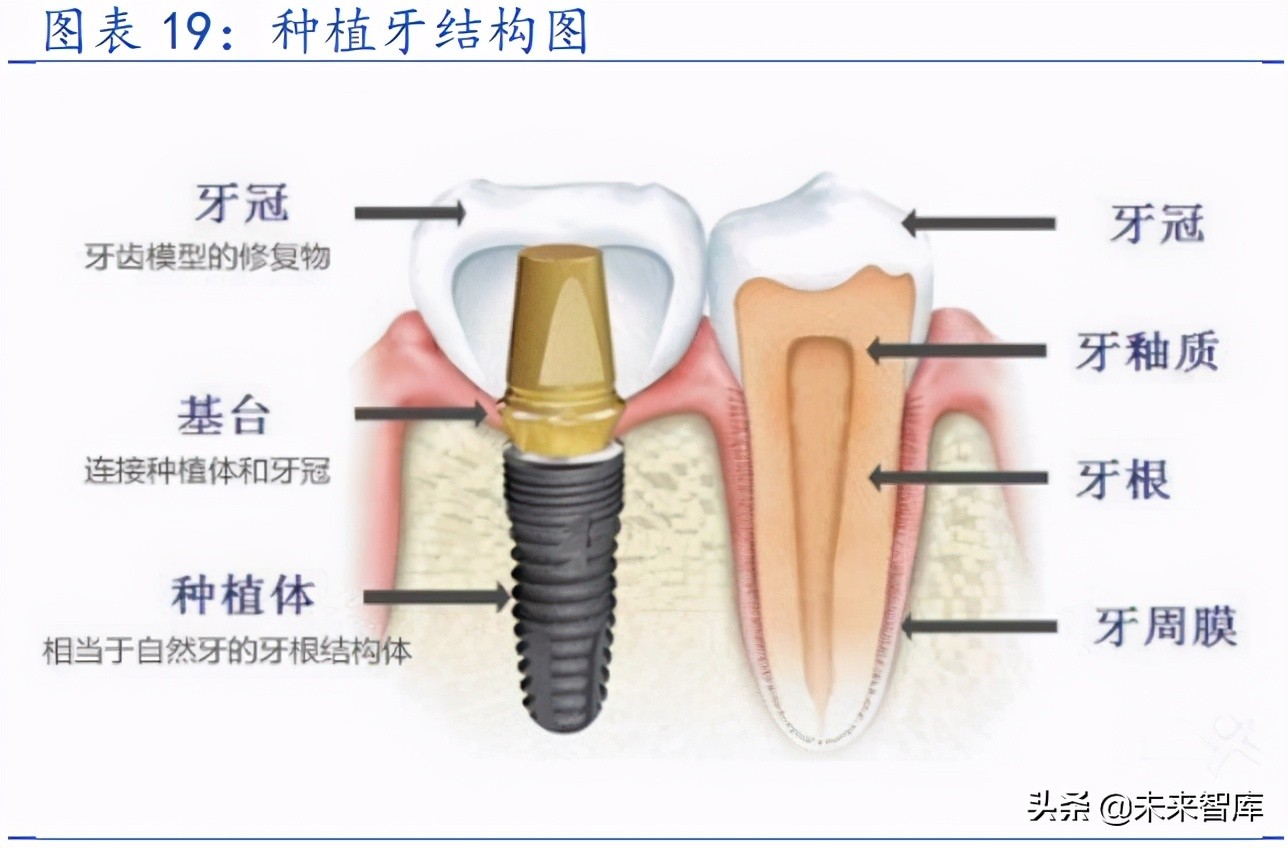 种植牙行业专题研究报告：千亿市场，国产种植牙耗材崛起正当时