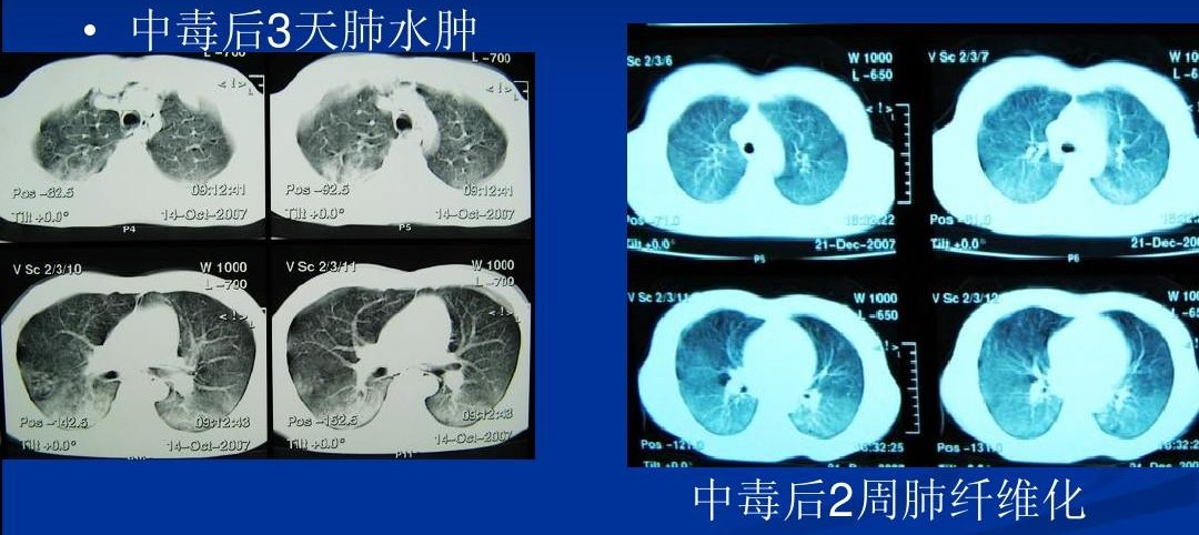 百草枯——被人喝到禁售的产品，让它的发明者都深有负罪感