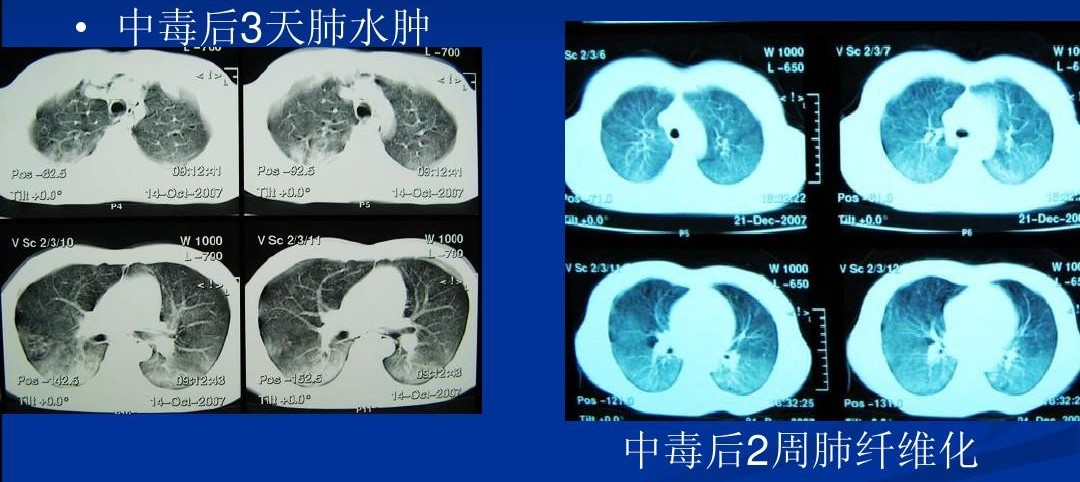 百草枯——被人喝到禁售的產(chǎn)品，讓它的發(fā)明者都深有負(fù)罪感