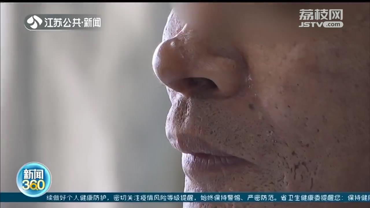 男子被狗咬掉鼻头 南京医生用额头组织再造，经三次手术修复