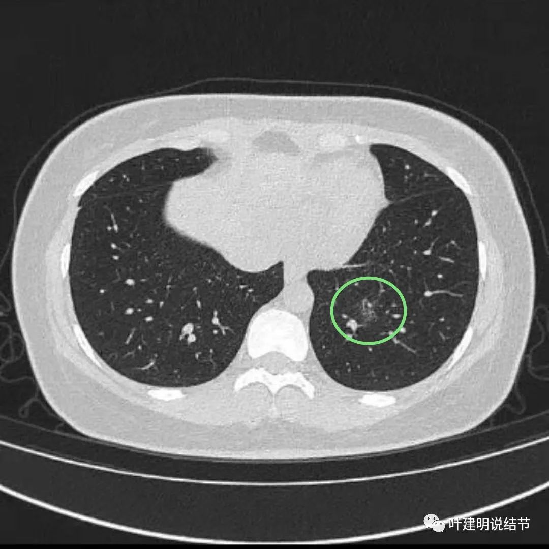 肺磨病友要沉住气--省市两级医生考虑早期<!--HAODF:8:feiai-->肺癌<!--HAODF:/8:feiai-->的结节消失了