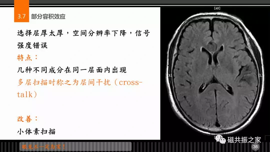 磁共振常见伪影及策略