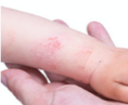 夏季儿童常见皮肤病的药物治疗及防治小窍门