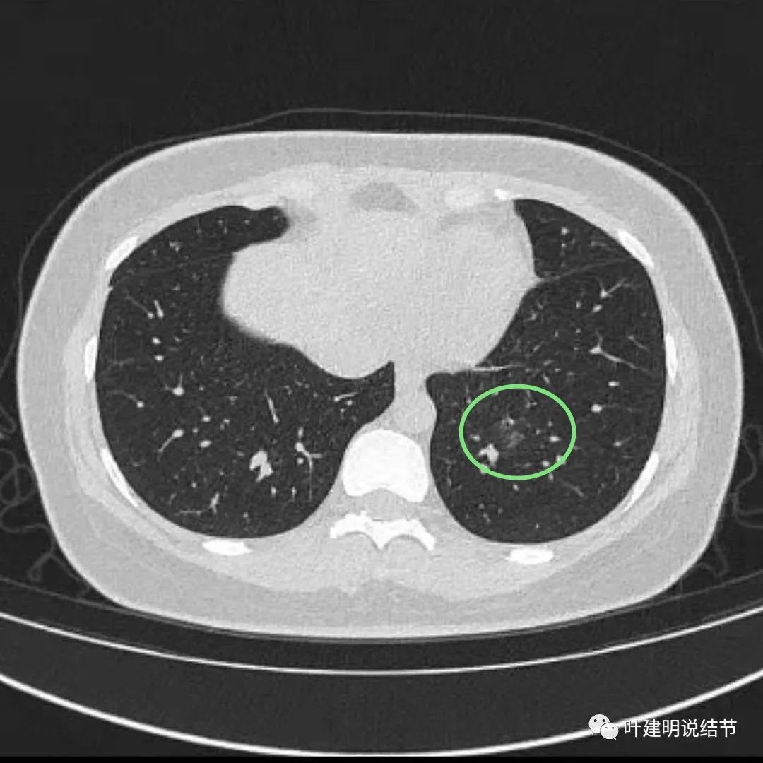 肺磨病友要沉住气--省市两级医生考虑早期<!--HAODF:8:feiai-->肺癌<!--HAODF:/8:feiai-->的结节消失了