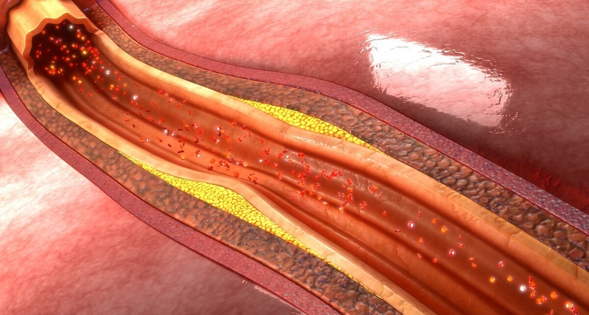 預(yù)防心肌梗死的關(guān)鍵，不是消除硬化斑塊，而是增加斑塊的穩(wěn)定性