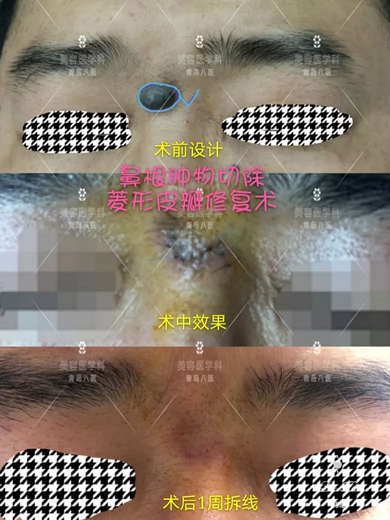 技术｜小切口，大学问——青岛市第八人民医院美容医学科