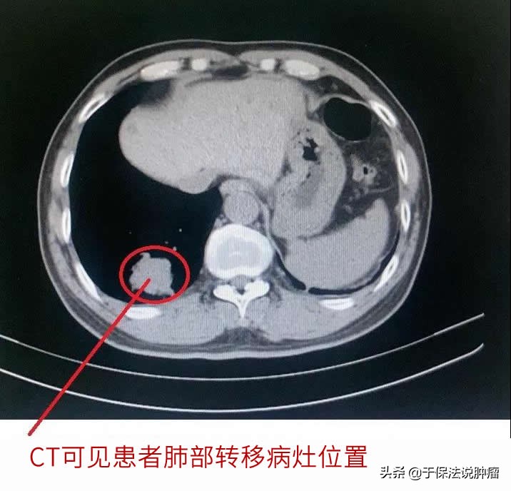 鼻咽癌肺转移患者，接受缓释库超微创治疗后好转