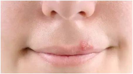 如果你唇周长痘，可能是你对象肠胃感染细菌，唇周长痘三大原因？