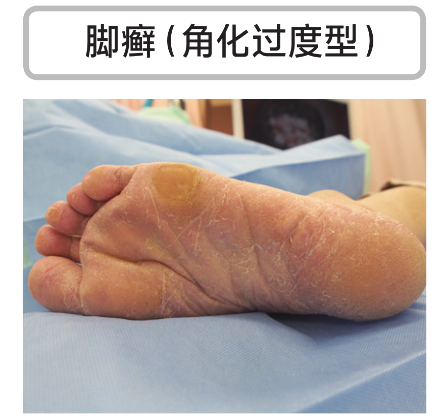 硬邦邦的老茧 会痛的鸡眼 日本皮肤科专家教你矫正足部恶习 健康与美容 Mdeditor