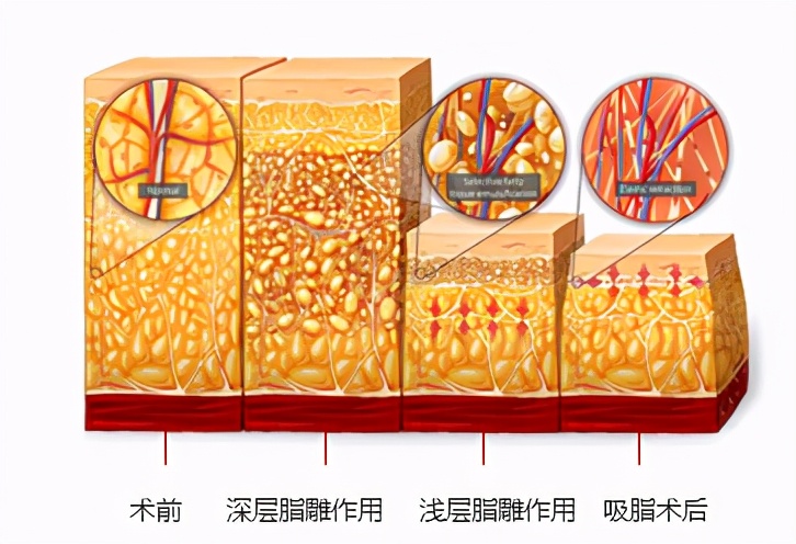 医美暗影：藏在脂肪类手术中的顽疾