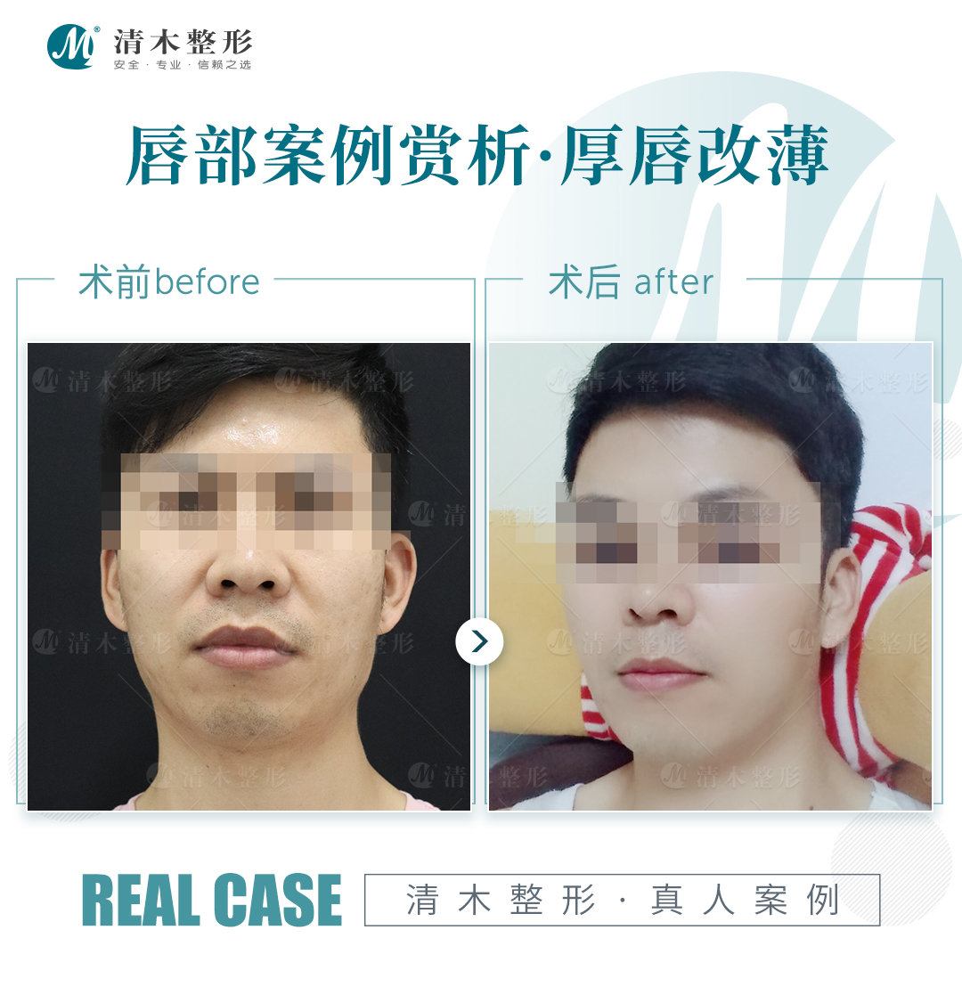 关于厚唇改薄，你需要知道这些