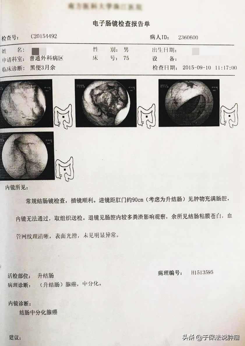 结肠癌术后肝转移患者，接受缓释库治疗后好转