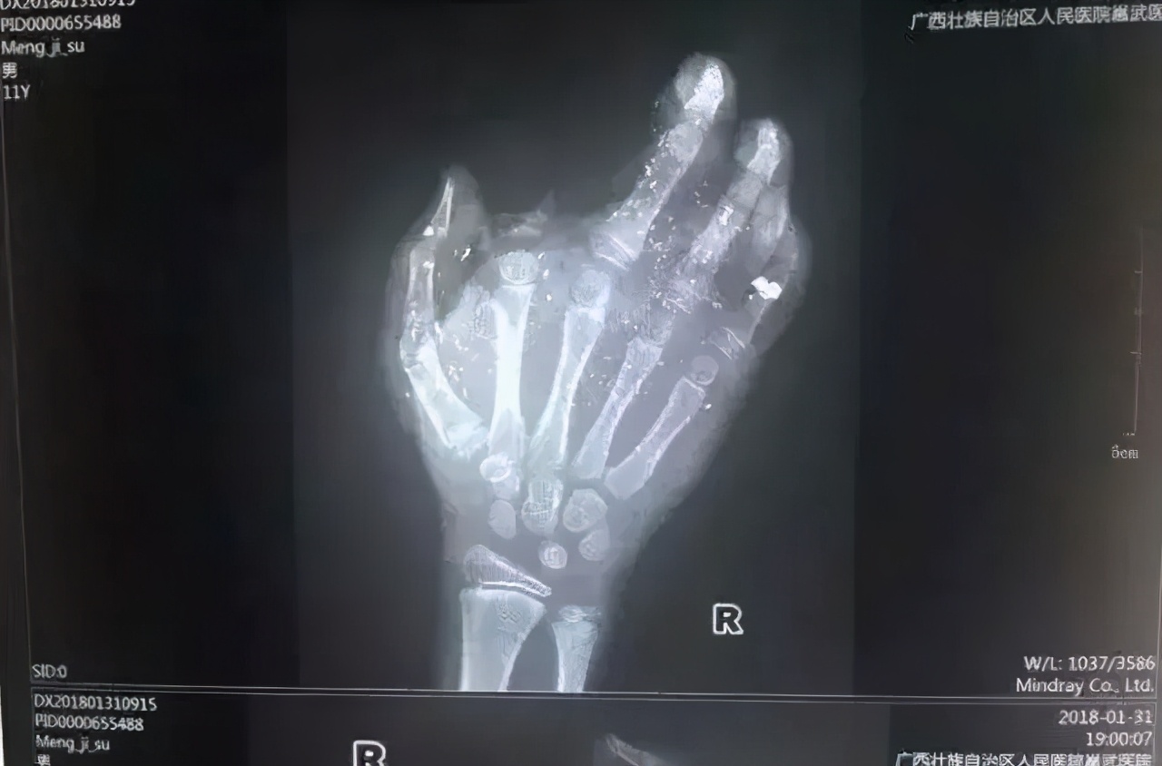 手机充满电不拔插头？火！
