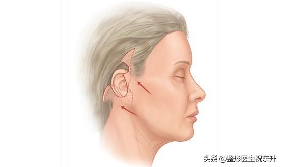 55岁以上的人做面部提拉，应该选大拉皮手术？