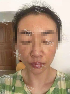 「唯诺雅淡斑反馈」秋季是祛斑的黄金周期