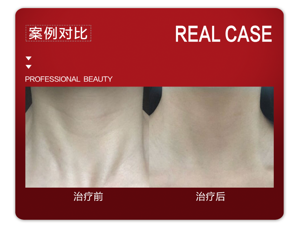 嗨体水光，颠覆你对水光针的认知