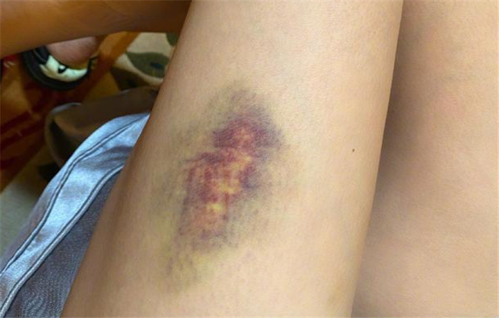 沈梦辰晒大腿受伤照，杨迪火速评论，网友：杜海涛又要吃醋了