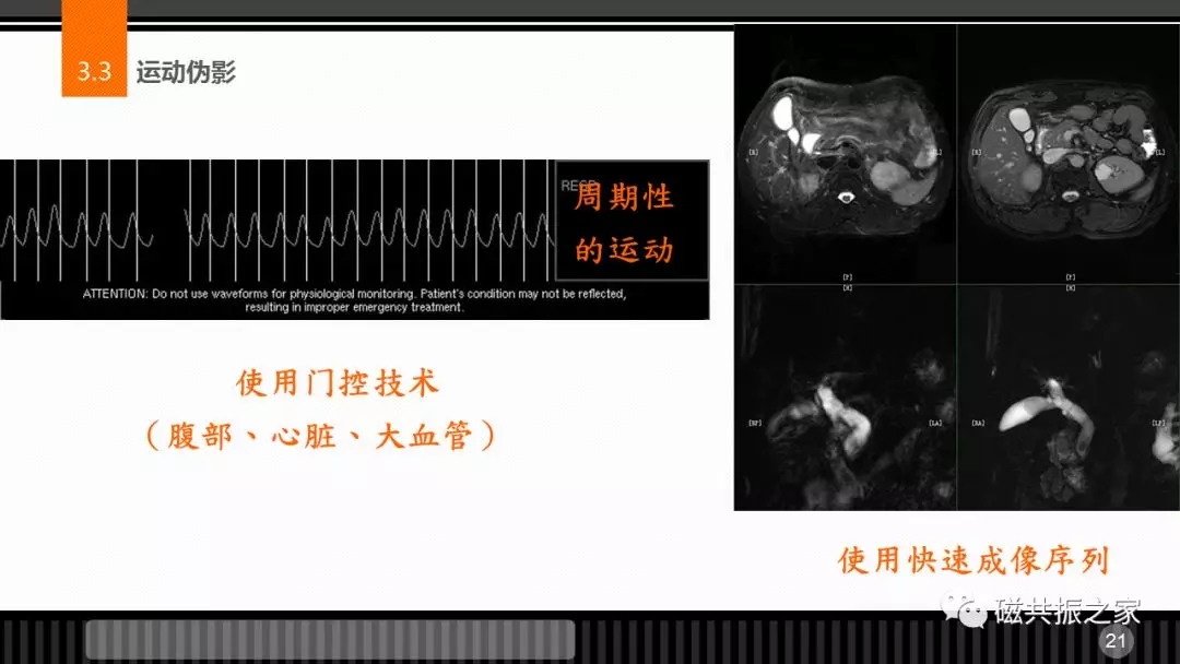磁共振常见伪影及策略