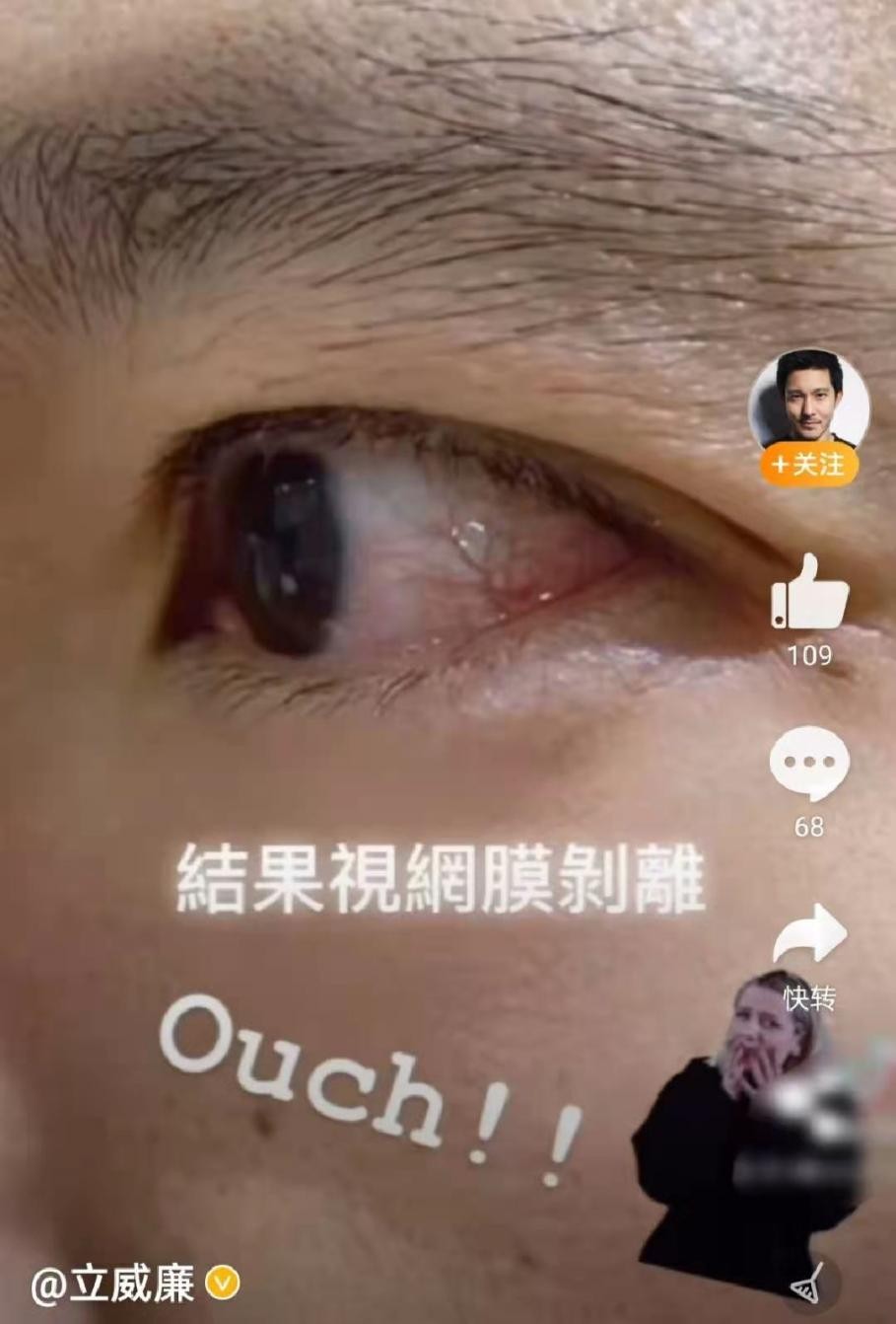 立威廉被女兒踢傷眼睛！ 視網膜剝離緊急手術，馬虎大意險釀成慘禍