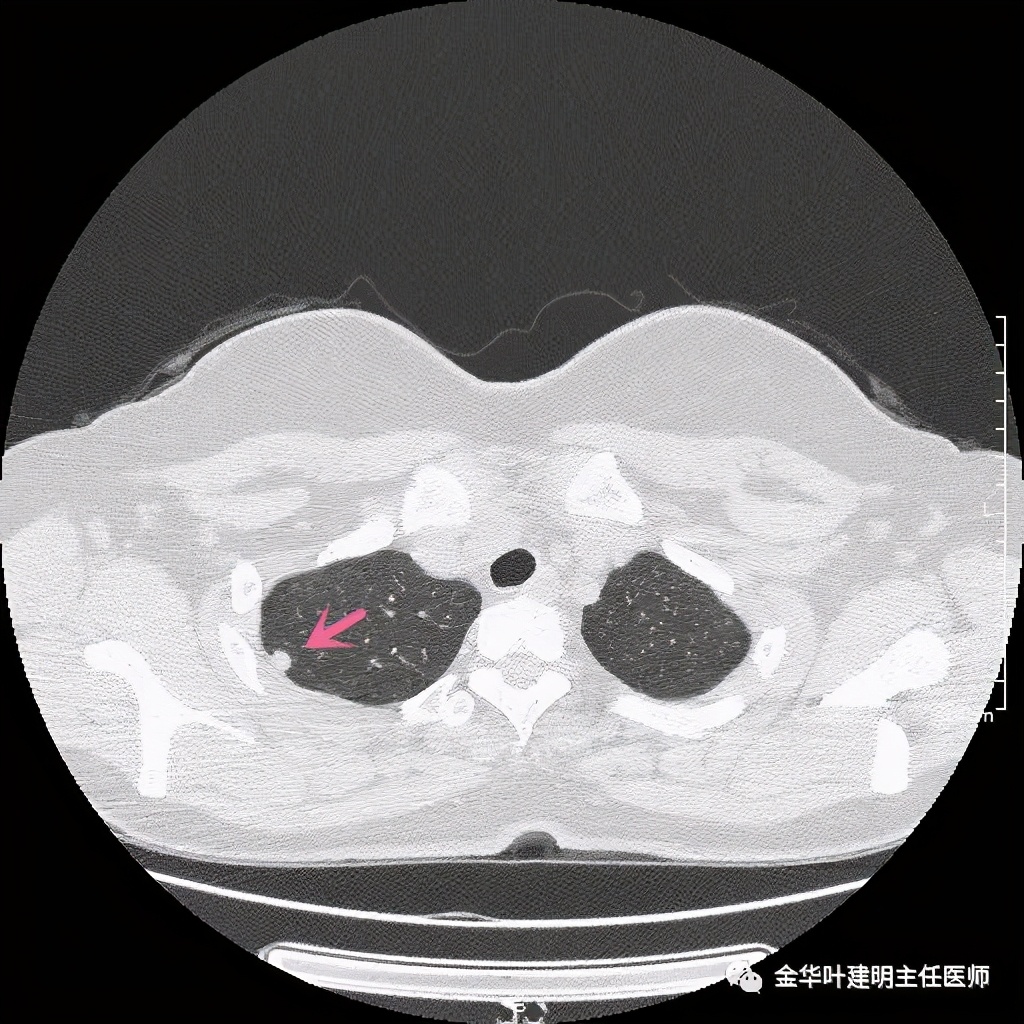 随访明显增大的实性<!--HAODF:8:jiejiebing-->肺结节<!--HAODF:/8:jiejiebing-->肯定是癌吗？要不要手术？