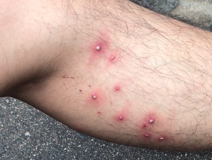 毛囊炎是否都是细菌感染所致,当然不是,许多原因可以引起"毛囊发炎"