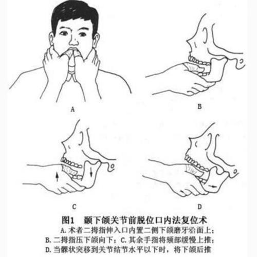 一不小心下巴就脱臼？有哪些复位方法？